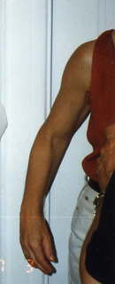 arm