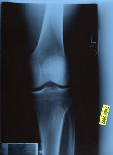 Adam's knee X-ray 1