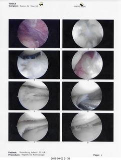 42 9f5. knee surgery images