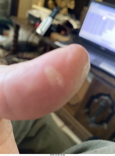 blistered thumb from soldering misadventure