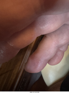 Adam's infected finger