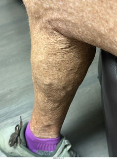 veins on my calves